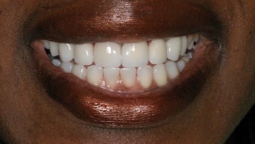 Healthy smile with proportional tooth and gum tissue