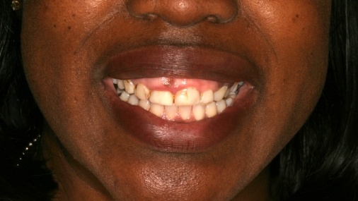 Gummy smile before cosmetic dentistry