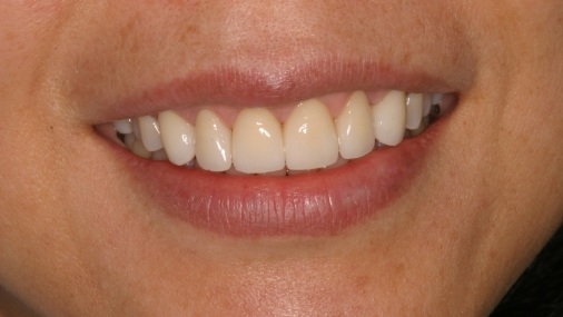 Smile with flawless new dental restoration