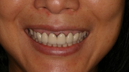 Smile with discolored dental restoration