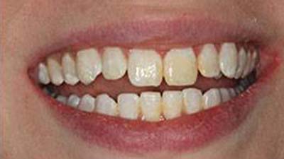 closeup of patient's smile before treatment