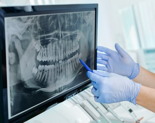 Digital dental x-rays on computer screen