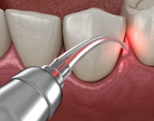 Animated smile during soft tissue laser dentistry treatment