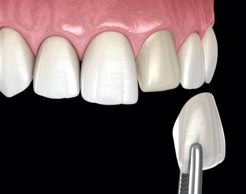 Animated smile during porcelain veneer placement