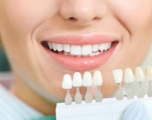 Smile compared with tooth shades after teeth whitening