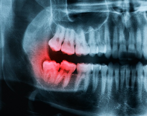 X-ray of impacted wisdom teeth in need of extraction