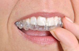 clear aligners