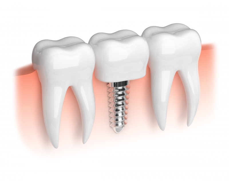 3D model of a dental implant
