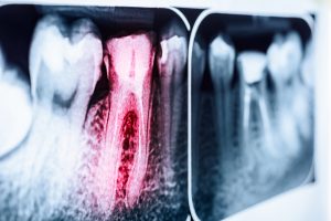 x-ray of tooth needing root canal