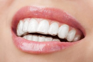 smiling face with invisalign alignment tray