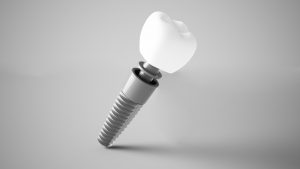 Digital image of a dental implant