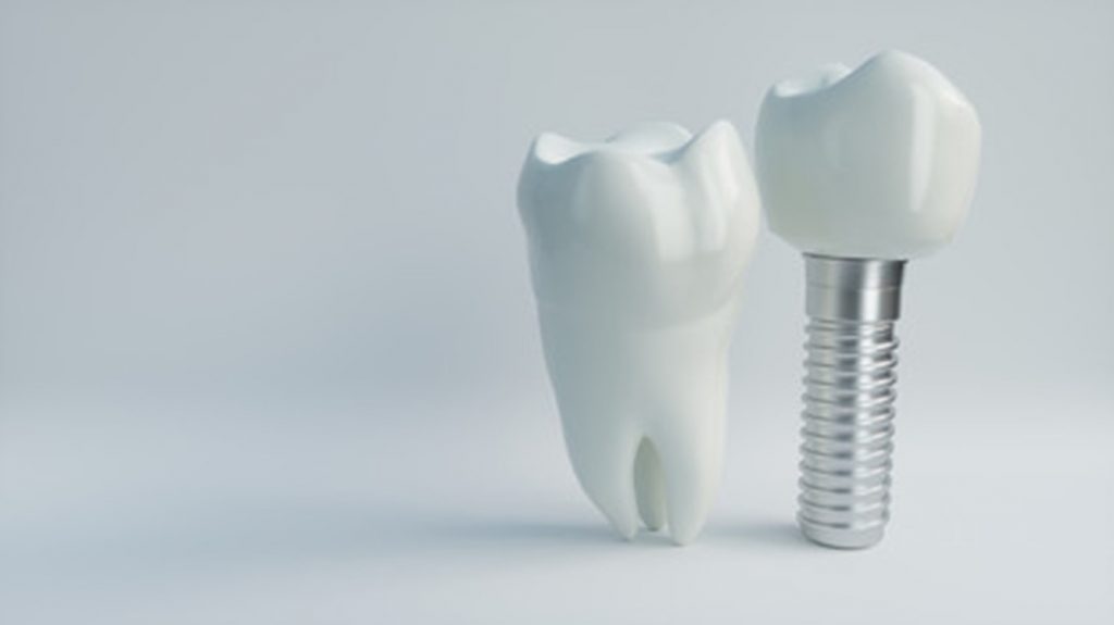 Image of dental implants.