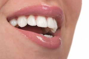 woman smiling with porcelain veneers